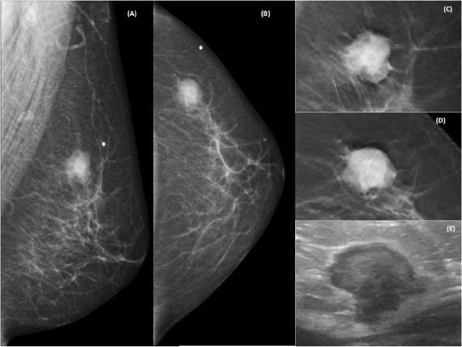 Left mammography in oblique mediolateral (a) and craniocaudal (b) views, featuring a high-density nodule, irregularly shaped and indistinct and spiculated margins, best assessed in tomosynthesis (c) and (d), located at the upper-outer quadrant, corresponding to the palpable complaint – BI-RADS® 4C. Ultrasonography (e) shows a nodule of solid, hypoechoic, irregular and angled nature.