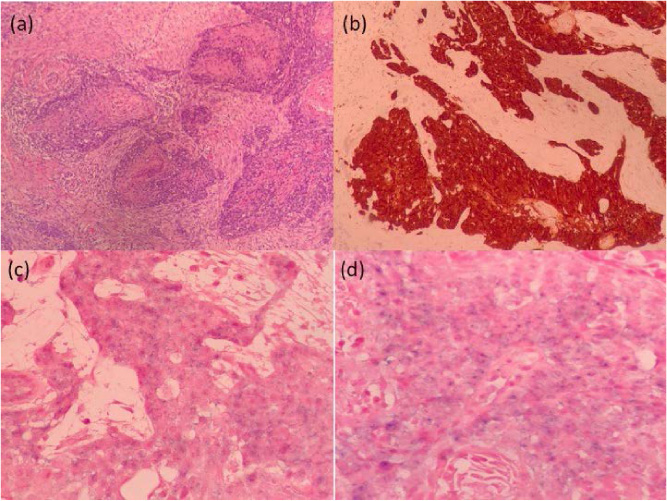 Histology - (a) invasive carcinoma with squamous differentiation and keratinization in breast segmentectomy material (Histological section, hematoxylin and eosin, 100x); (b) strong and diffuse immunopositivity for the p16 marker (p16, DAKO, 200 x); (c and d) detection of signals by the in-situ hybridization technique (ISH) for high risk HPV (Ventana Infomr HPV III Family 16 probe for HPV genotypes 16, 18, 31, 33, 35, 39, 45, 51, 52, 56, 58 and 66) - 200 and 400x increase, respectively.