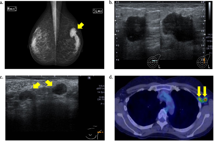 a. Mammogram. A dense, oval, finely serrated marginal mass with microcalcifications can be seen in the left M-O segment. b. Echocardiogram. A 1.5 × 1.6 × 2.4 cm lobulated mass shadow with unclear borders can be seen in the left C segment. c. Ultrasonographic scan. Left axillary swollen axillary lymph nodes of 13 mm and 11 mm in size can be seen. d. Positron emission tomography-computed tomography scan Hyper-uptake consistent with the mass can be seen in the left breast and left axillary lymph node (left breast: SUVmax, 15.2, left axillary lymph node: SUVmax, 9.5). No obvious distant metastases can be seen. SUVmax, maximum standardized uptake value.