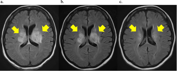 a. Head FLAIR-MRI scan obtained at admission. High-density areas in both basal ganglia and marked compression of both ventricles can be seen. FLAIR-MRI, Fluid-attenuated inversion recovery-magnetic resonance imaging b. Occipital FLAIR-MRI obtained 2 weeks after the start of treatment. A reduction in the high-density areas of the bilateral basal ganglia and an improvement in the compression of the bilateral ventricles can be seen. FLAIR-MRI, Fluid-attenuated inversion recovery-magnetic resonance imaging. c. Occipital FLAIR-MRI obtained 3 months after the start of treatment. Further reduction of the high-density areas of the bilateral basal ganglia and further improvement of the compression of the bilateral ventricles can be seen. FLAIR-MRI, Fluid-attenuated inversion recovery-magnetic resonance imaging.