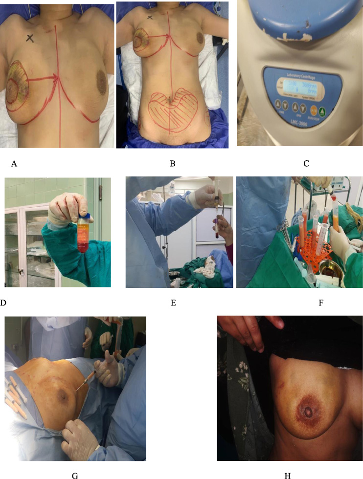 (A) 44 years old female patient who had CBT (Round block technique followed by RT), suffered a defect at the site of surgery. (B) Preoperative marking at both donor and recipient sites. (C) Centrifuge. (D) Centrifuged fat is separated into three layers: upper oily layer, middle purified fat and lower blood and debris. (E) Aspiration of upper layer (PRP). (F) Enriching the fat graft by PRP. (G) Injection of PRP enriched fat graft. (H) Six months follow up with satisfactory result after one session.