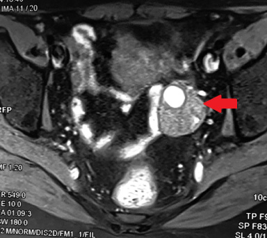 Abdominal MRI: Left ovarian infiltration classified as AdnexMR score 5.