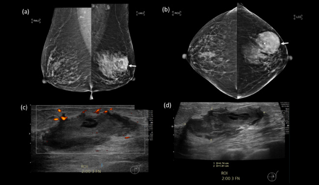 (a, b) Mediolateral-oblique (MLO) and cranio-caudal (CC) mammographic views of both breasts, with a dense mass in the upper outer quadrant of the left breast (arrows). (c, d) Targeted ultrasound of the left breast showed an irregular cystic lesion with internal debris at the 2 o’clock position, 3 cm from the nipple. Mild peripheral vascularity was noted.
