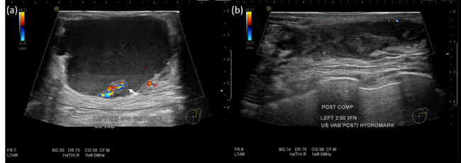 (a) Pre-biopsy ultrasound demonstrating a focal papillary component with prominent vascularity (arrow). (b) Post-biopsy ultrasound showed significant reduction in size of the lesion.