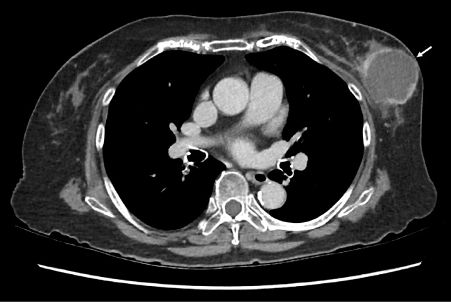 Staging CT performed 2 weeks after the biopsy demonstrating recurrence of the lesion in the left breast, with thickened, irregular and enhancing walls (arrow).