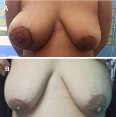 Preoperative and postoperative photos for Case 1: A. Preoperative photo showing right breast mass. B. Postoperative outcome after reconstruction.