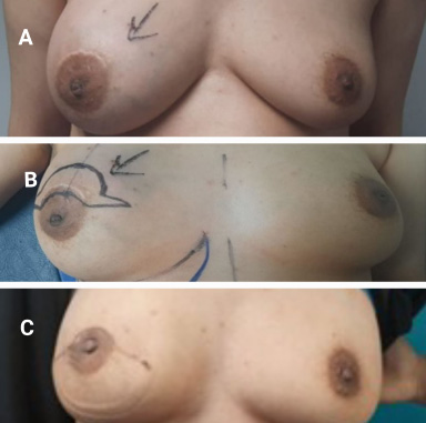 Preoperative and postoperative photos for Case 2: A. Preoperative photo showing right breast mass. B. Preoperative incision design (batwing mammoplasty). C. Postoperative outcome after reconstruction.