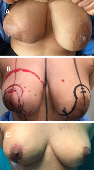 Preoperative and postoperative photos for Case 3: A. Preoperative photo showing right breast mass. B. Preoperative incision design (right skin-reducing mastectomy with left reduction mammoplasty). C. Postoperative outcome after reconstruction.