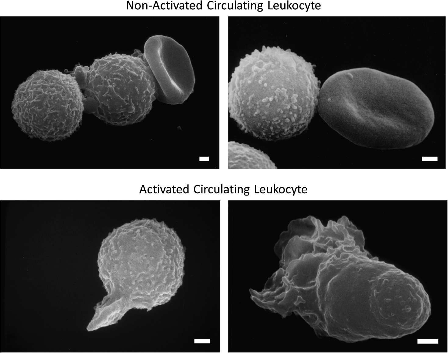 Scanning electron micrograph of fresh, untreated, circulating leukocytes (predominantly neutrophils and monocytes) in venous blood derived from the free circulation. Cells in the top row have low levels of pseudoformation and represent a non-activated (passive) state, and in bottom row exhibit an activated state with extensive pseudopods. Leukocytes of non-symptomatic healthy controls are rare in non-symptomatic control individuals but occur more frequently in circulating leukocytes of individuals with disease symptoms. Activation of circulating leukocytes may be accompanied by expression of membrane adhesion molecules, endothelial adhesion, oxygen free radical formation, degranulation, depletion glycocalyx, reduced response to fluid shear stress and other forms of cell activity. Length of bars is 1 μm.