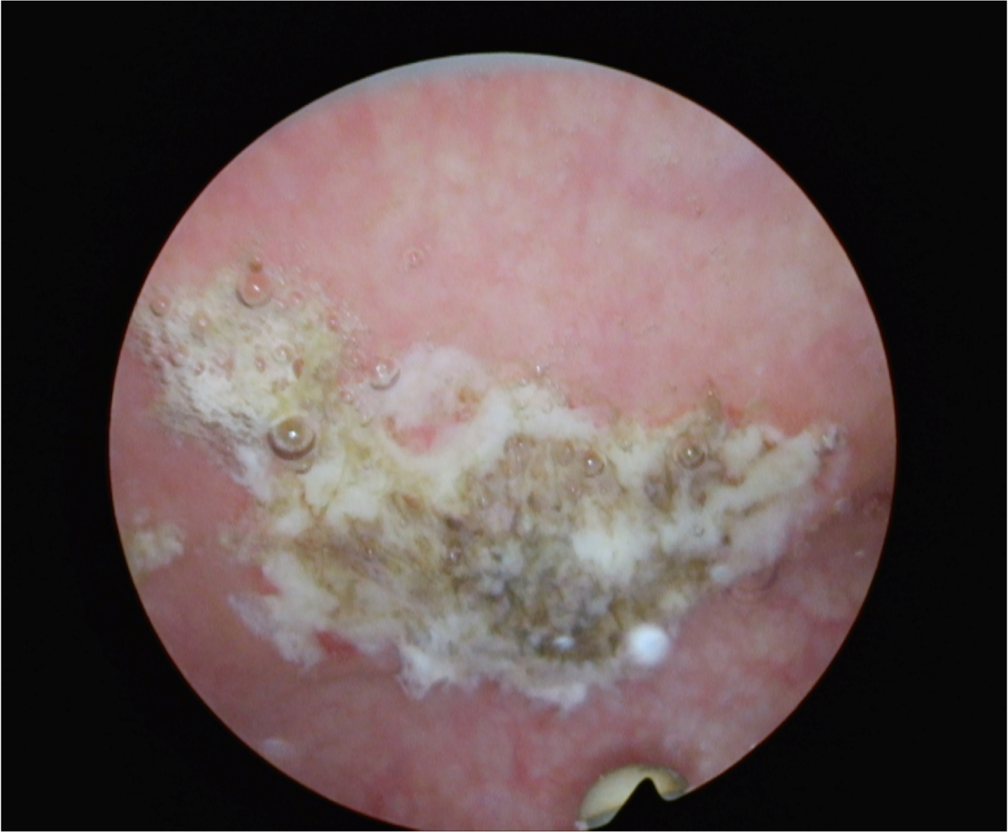 Post TUR BT. Cauterized area post resection.