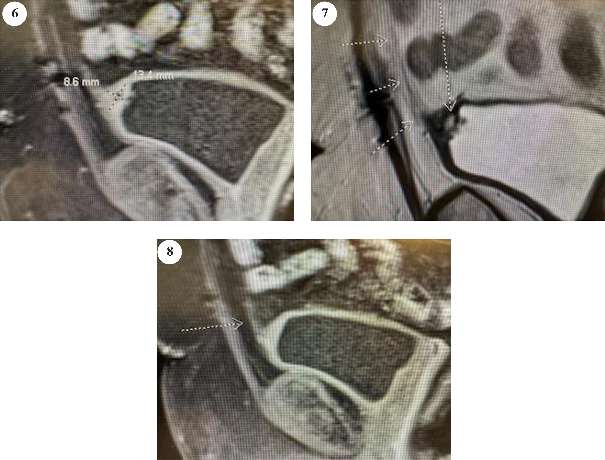 Post initial TUR BT imaging indicating mass involving the urachus.