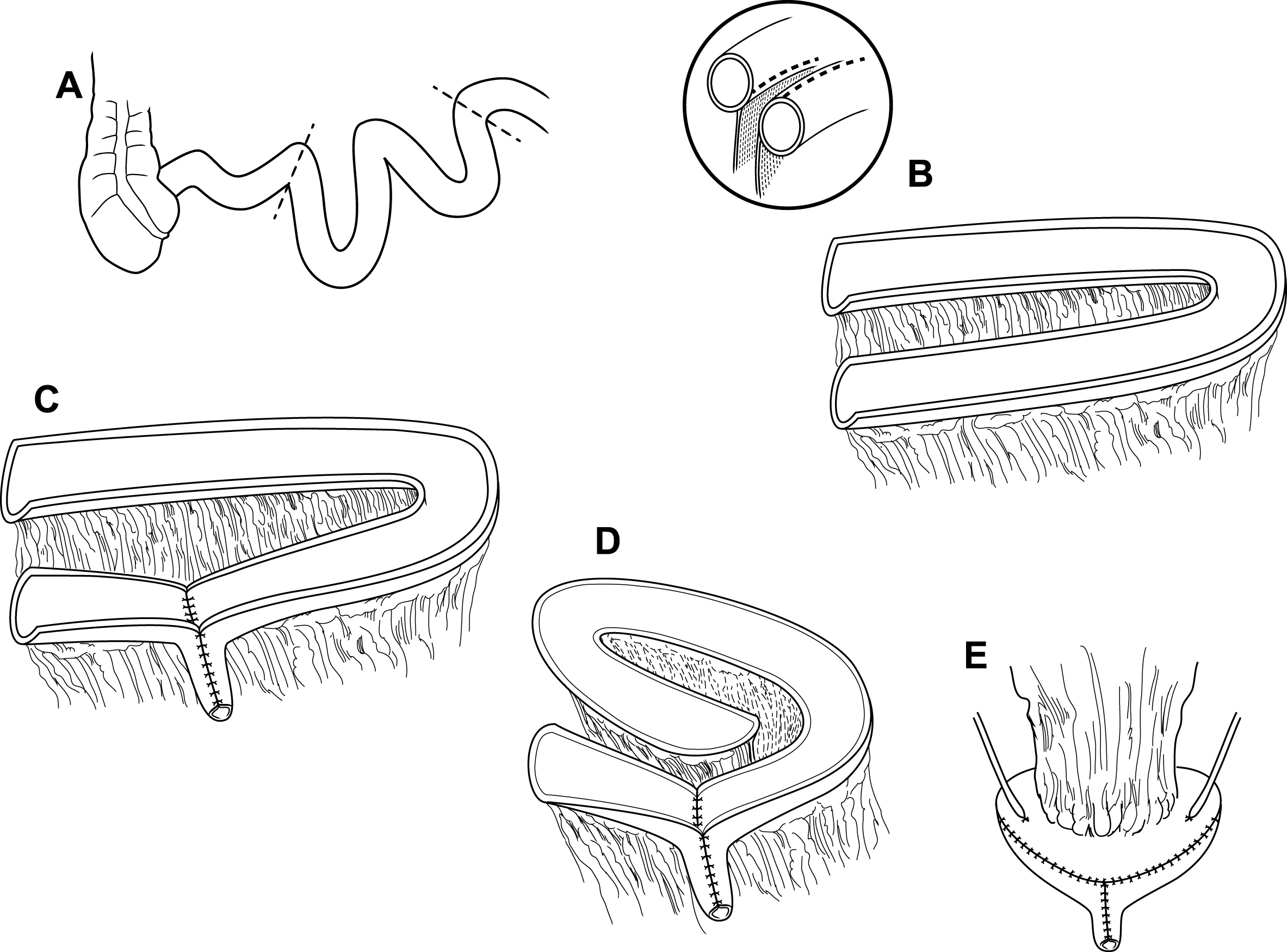 Modified VIP neobladder construction. (A) A 40–50 cm distal ileal segment is chosen approximately 15–20 cm from the ileocecal valve and (B) is folded into a sideways “U” configuration. The small bowel is opened longitudinally, close to the mesenteric border instead of along the true anti-mesentery. (C) The distal segment of bowel is tubularized into the neourethra and (D) the proximal segment is folded into a spiral configuration with adjacent bowel sutured together to approximate the new posterior wall. (E) The pouch is folded onto itself in a cephalad to caudad fashion and both ureters are reimplanted anteriorly on their respective sides.