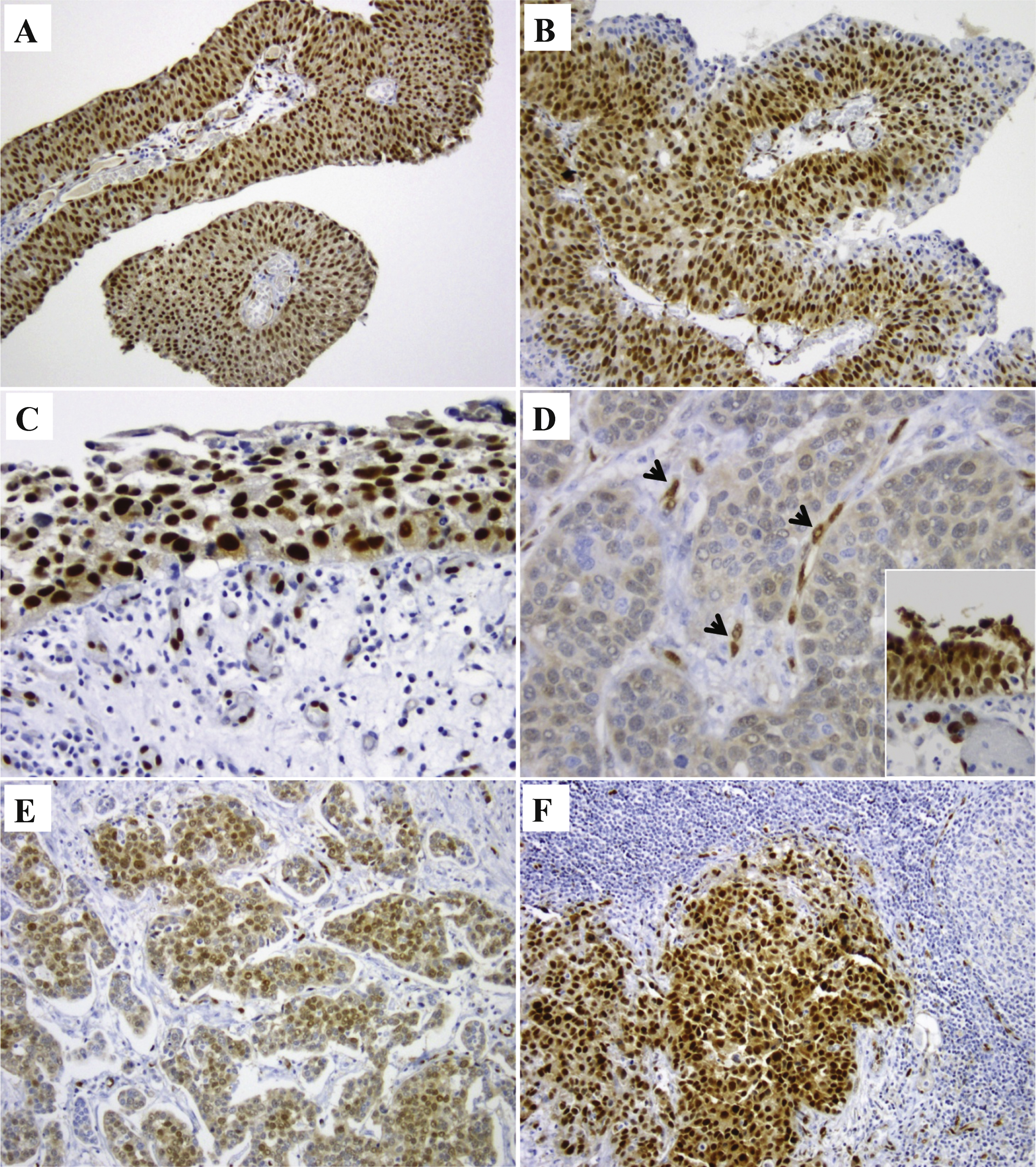 Id1 expression by immunohistochemistry in human samples. Positive expression in low grade papillary urothelial carcinoma (A); high grade papillary urothelial carcinoma (B); and urothelial carcinoma in situ (C). One sample of invasive urothelial carcinoma without Id1 expression (D, note Id1 expression in endothelial cells of tumor associated vasculature tumor [arrow heads] and Id1 protein expression in overlying normal urothelium [inset]). Id1 expression in invasive urothelial carcinoma (E) and matched lymph node metastasis (F).