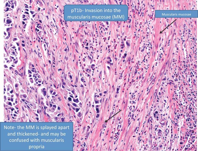 Pathologic substaging –pT1b denotes tumor invasion into the muscularis mucosae.