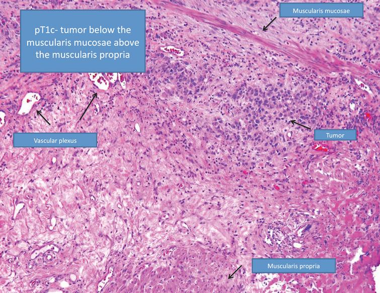 Pathologic substaging –pT1c denotes tumor invasion below the muscularis mucosae but above the muscularis propria.