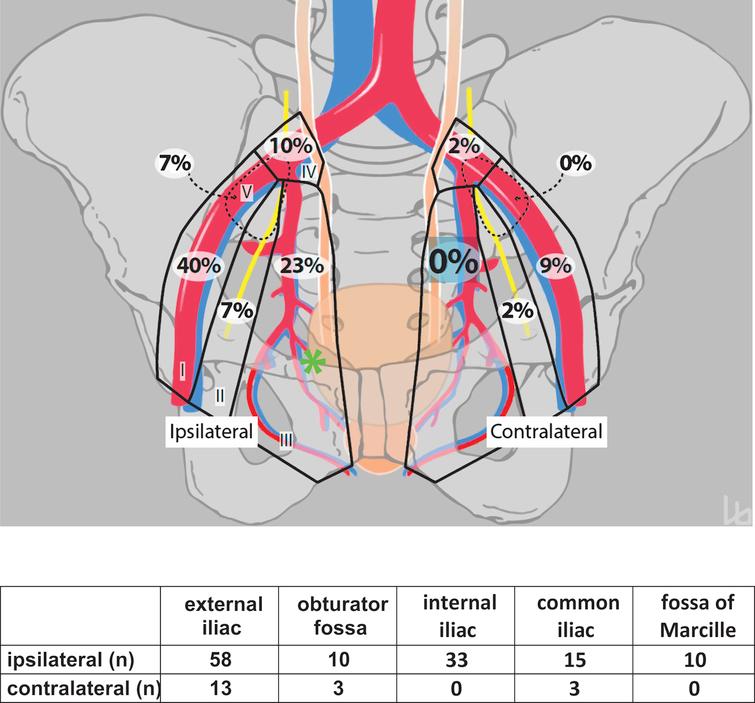 Schematic diagram showing the distribution of lymph node metastases (n = 145) of the lateral bladder walls (left and right) projected to a single side (right; asterisk). The pelvic lymph node dissection boundaries are subdivided into the (I) external iliac, (II) obturator fossa, (III) internal iliac, (IV) common iliac, and (V) fossa of Marcille regions.