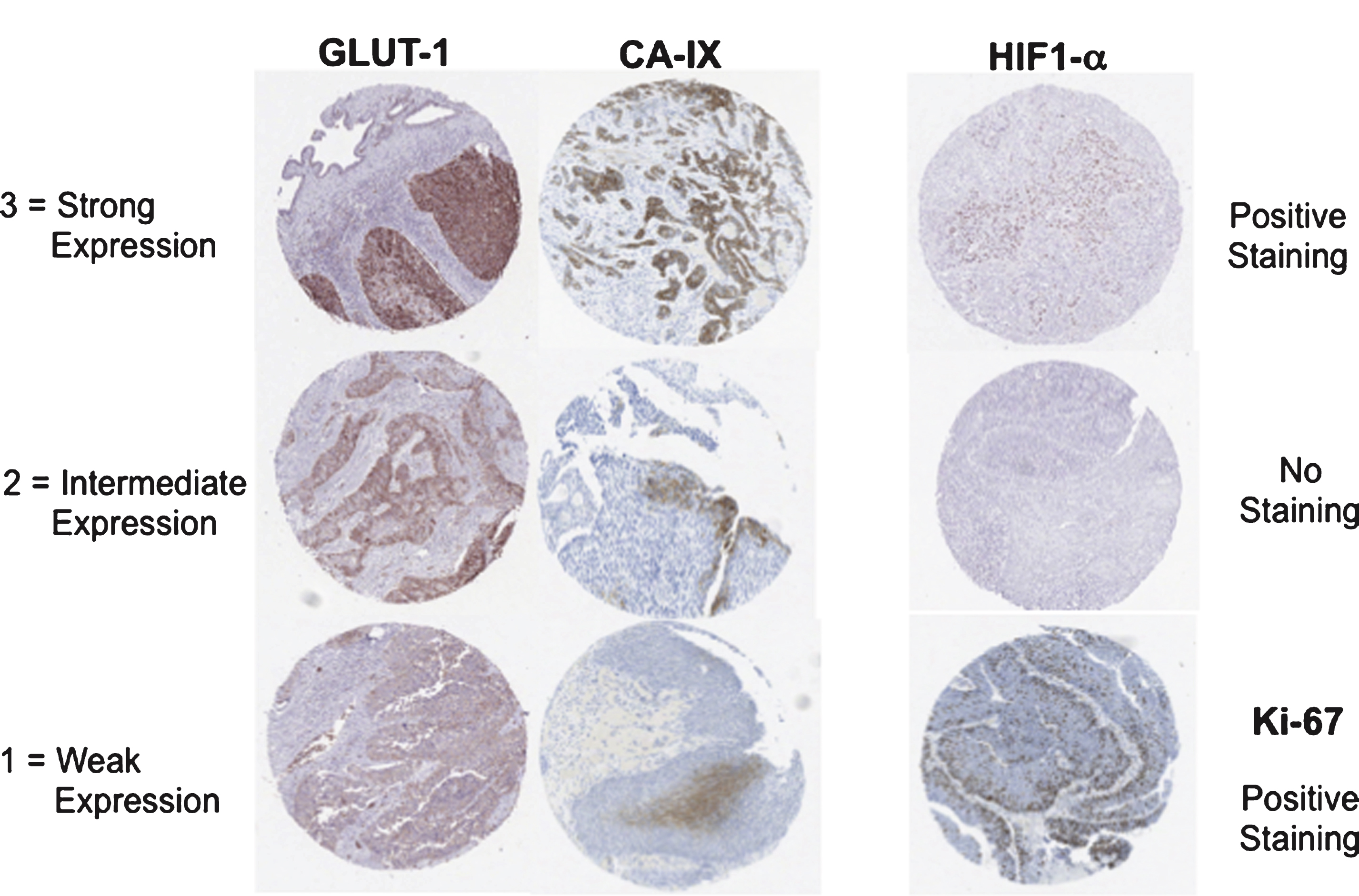 Expression status of hypoxia related markers in bladder cancer tissue. Immunohistochemistry staining of HIF1a, CA-IX, GLUT-1 and Ki-67 in paraffin-embedded TMA sections of bladder cancer tissues.