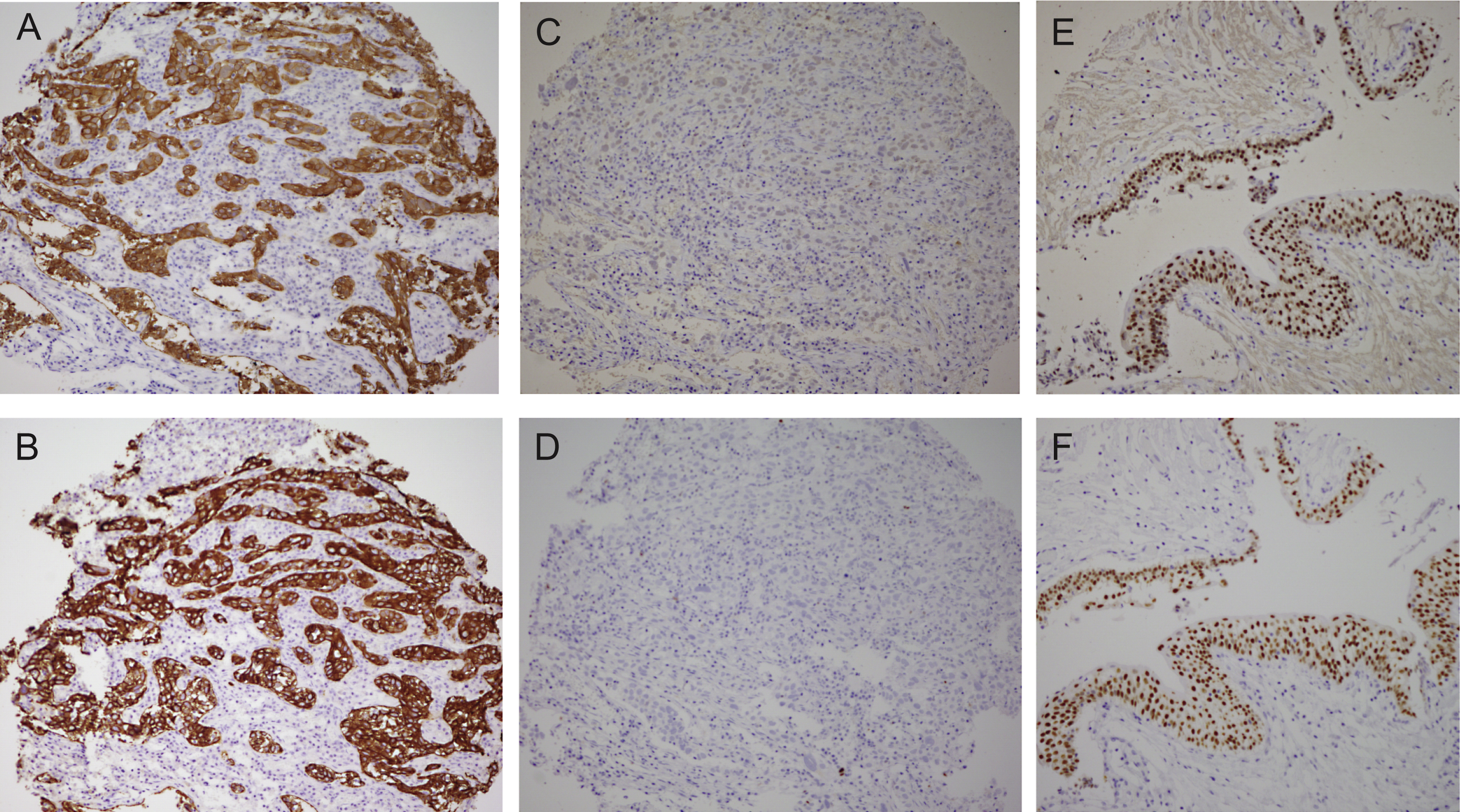
Basal/Squamous-like (BASQ) tumors are characterized by strong expression of KRT5/6 (A) and KRT14 (B) and low or undetectable expression of FOXA1 (C) and GATA3 (D). By contrast to them, normal urothelial cells display strong expression of FOXA1 (E) andGATA3 (F).