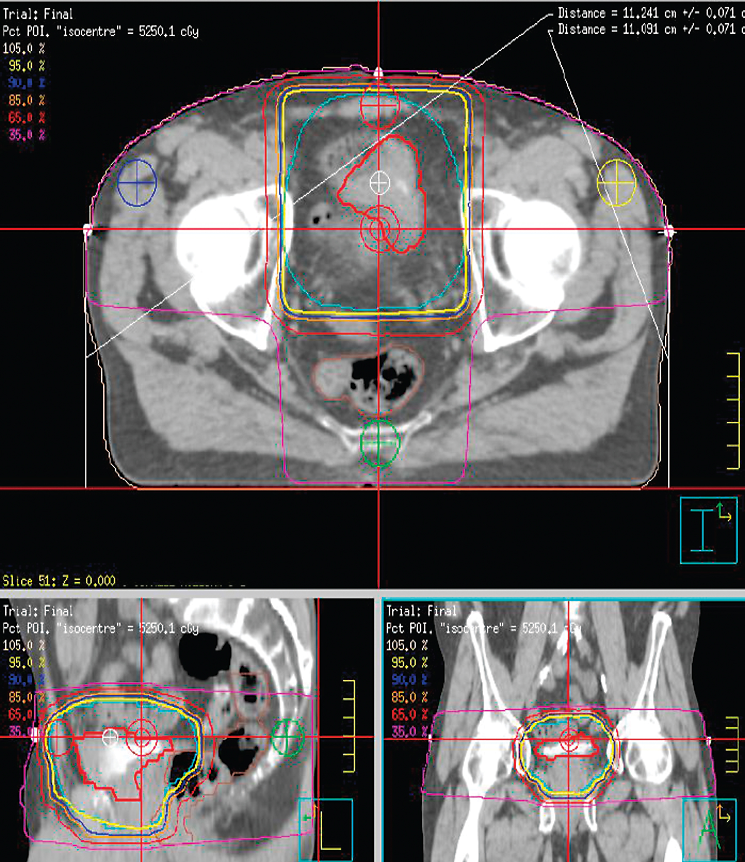 A typical 3 dimensional conformal radiotherapy plan for treating bladder cancer.