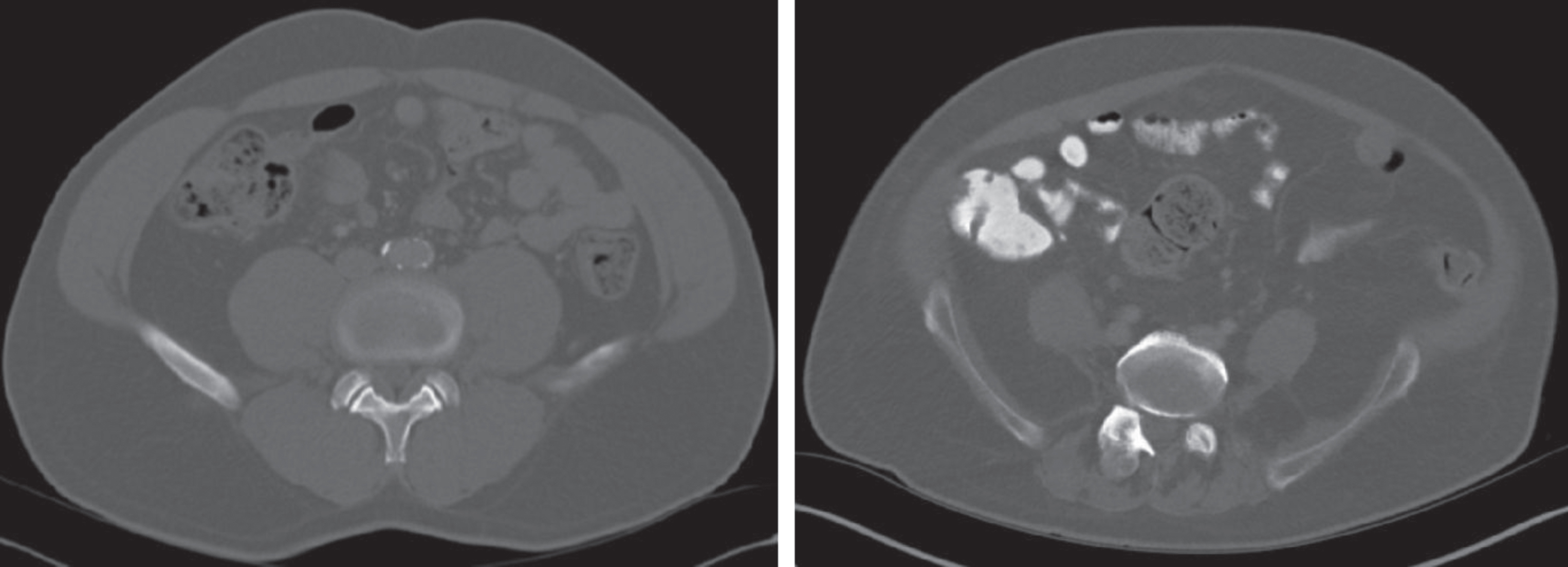 Variation in morphometric characteristics seen on pre-operative CT scan in two age-matched males of similar size, with similar comorbid conditions. CT on the left demonstrating high psoas muscle area, CT on the right demonstrating low psoas muscle area, both with respect to the mean.