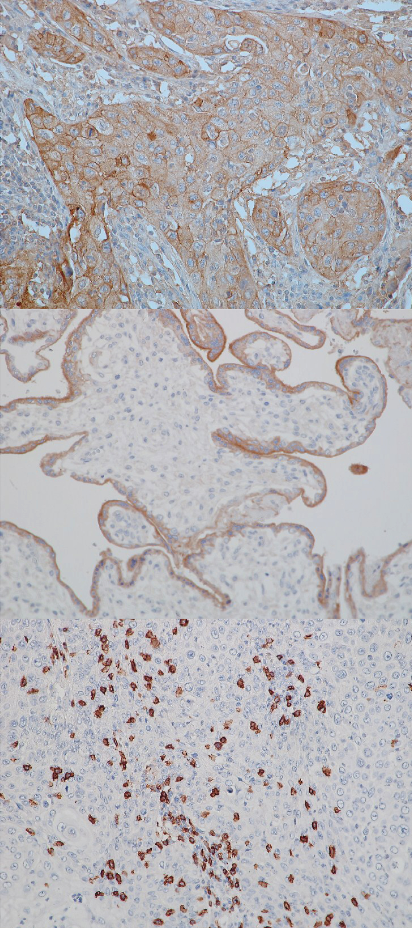 Exemplary stains for PD-L1 and CD8. From top to bottom: PD-L1 positive tumor, 20x; positive control (human placenta) for PD-L1, 20x; CD8 infiltration, 20x.