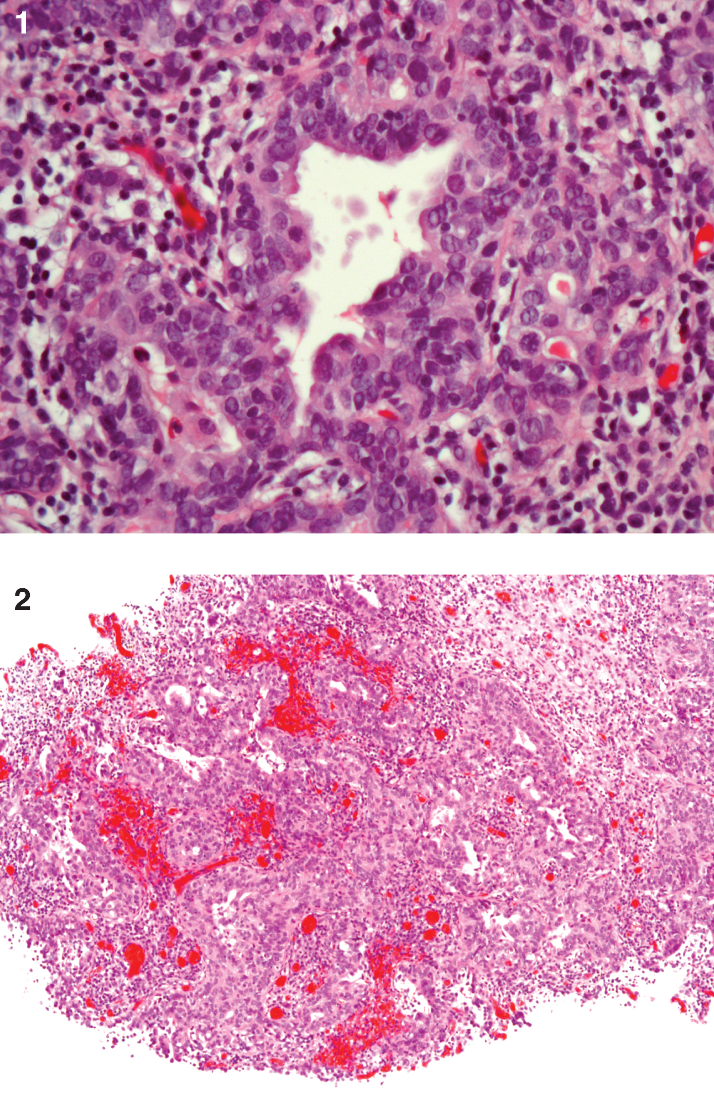 This is a high grade urothelial carcinoma (UC) with adenocarcinoma which is invasive into the lamina propria. Muscularis propria is present and not involved with cancer. There is an in situ component as well as an invasive component which is gland forming without mucin production. The tumor is GATA 3 positive (for UC). The tumor is >50% positive for Ki67.
