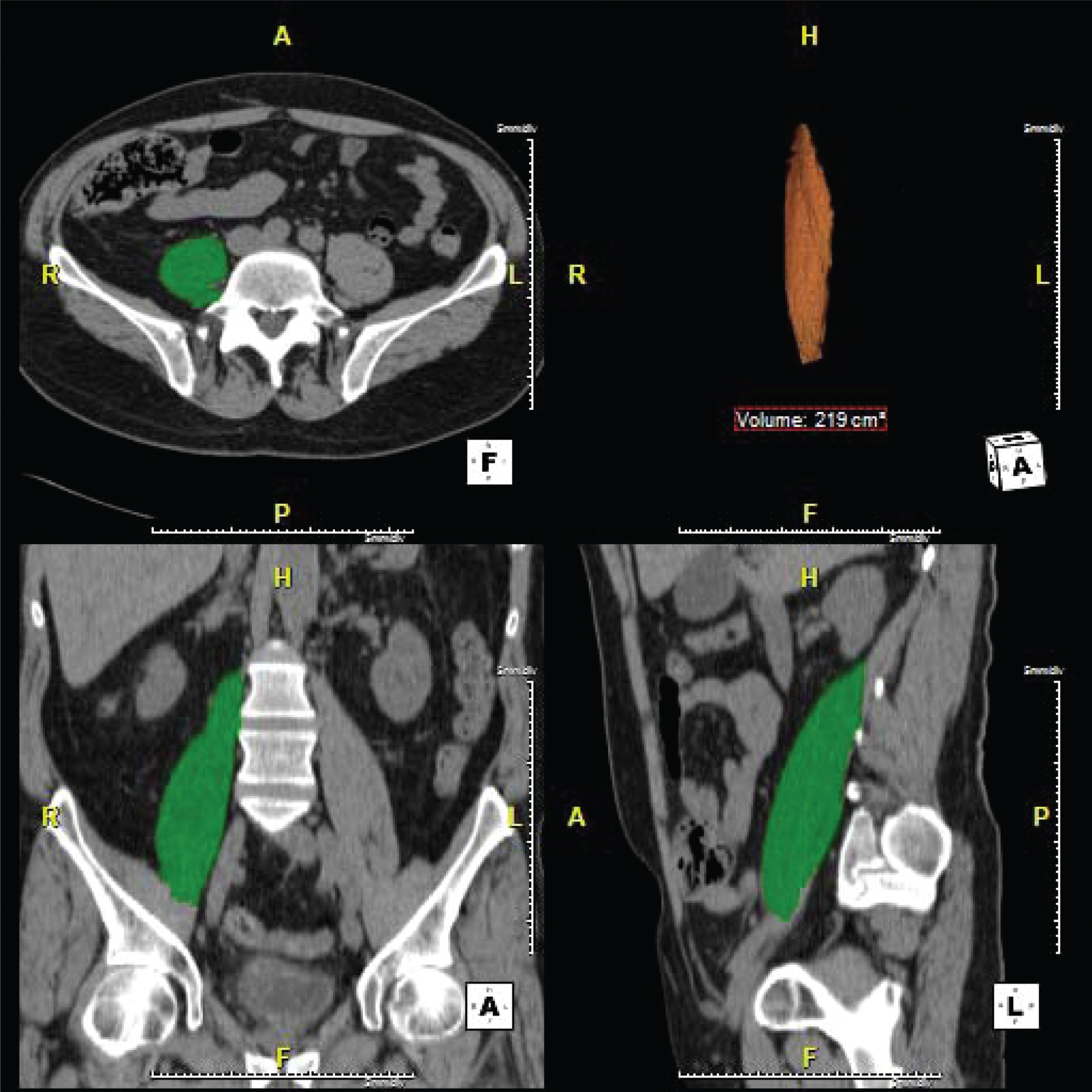 Cross sectional imaging demonstrating our method of psoas muscle volume assessment. Pre- and post- NAC psoas muscle volumes were measured from the origin of psoas at the level of the lumbar vertebrae to its insertion in the lesser trochanter on CT datasets using a semi-automatic segmentation method. The proportional change in psoas muscle volume (PMV) was calculated by dividing the change in PMV by the pre-NAC PMV (ΔPMV/pre-NAC PMV) and is reported as percentage of PMV.