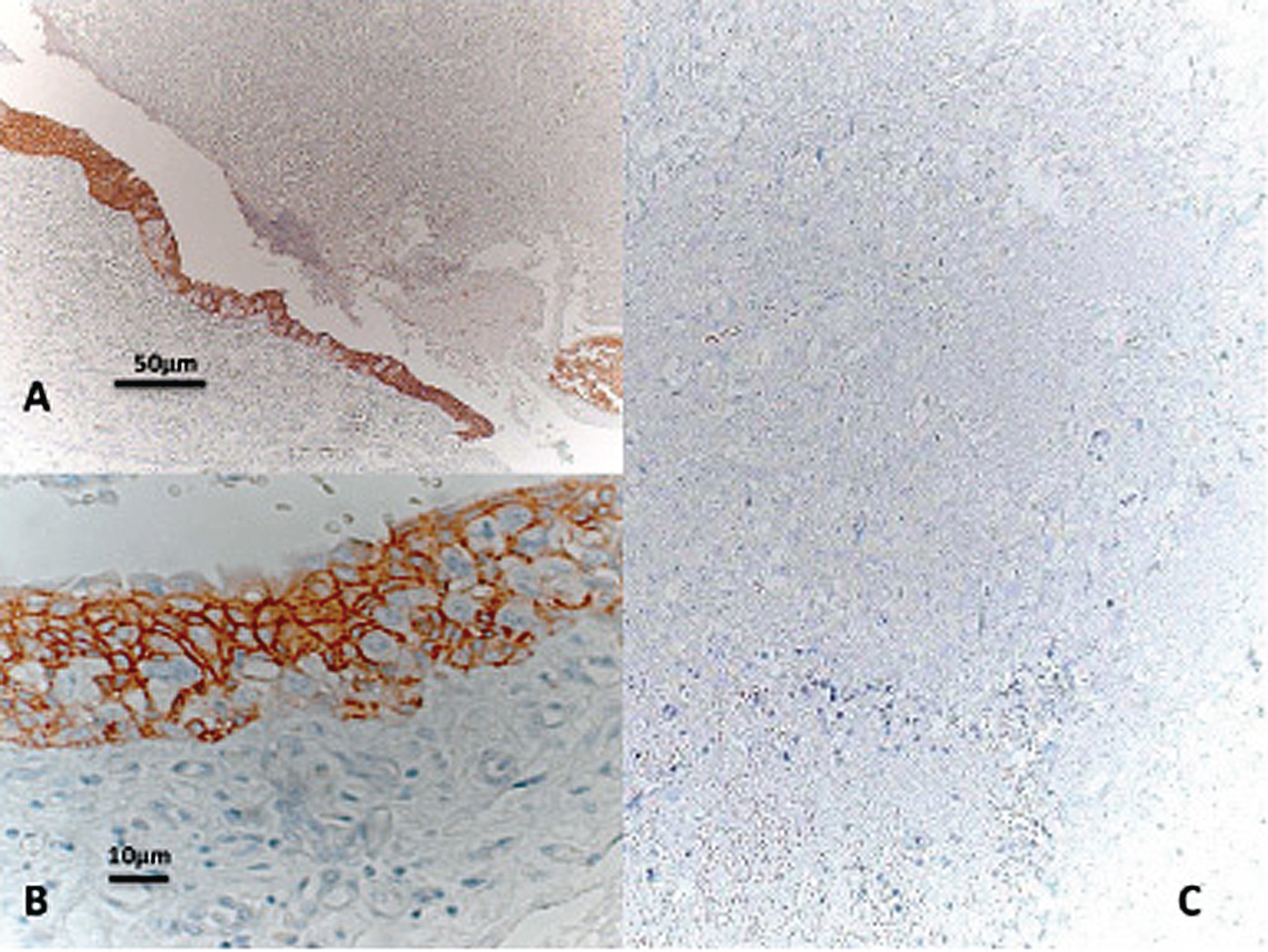(A-C) Carcinama in situ showing 
intense AQP3 expression (10 fold mognification, A; 40 fold magnification, B). Note the complete loss of AQP3 in 
the associated adjacent muscle-inasive tumor (C).