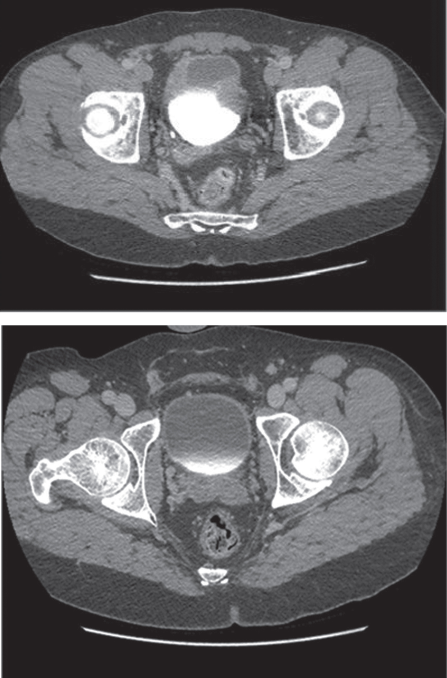 CT scan of MMC cystitis: pre-algorithm treatment image demonstrates bladder wall thickening suggestive of bladder cancer recurrence; however, this was biopsy proven MMC cystitis. The post-treatment image on the bottom was following steroids and antihistamine treatment per algorithm.
