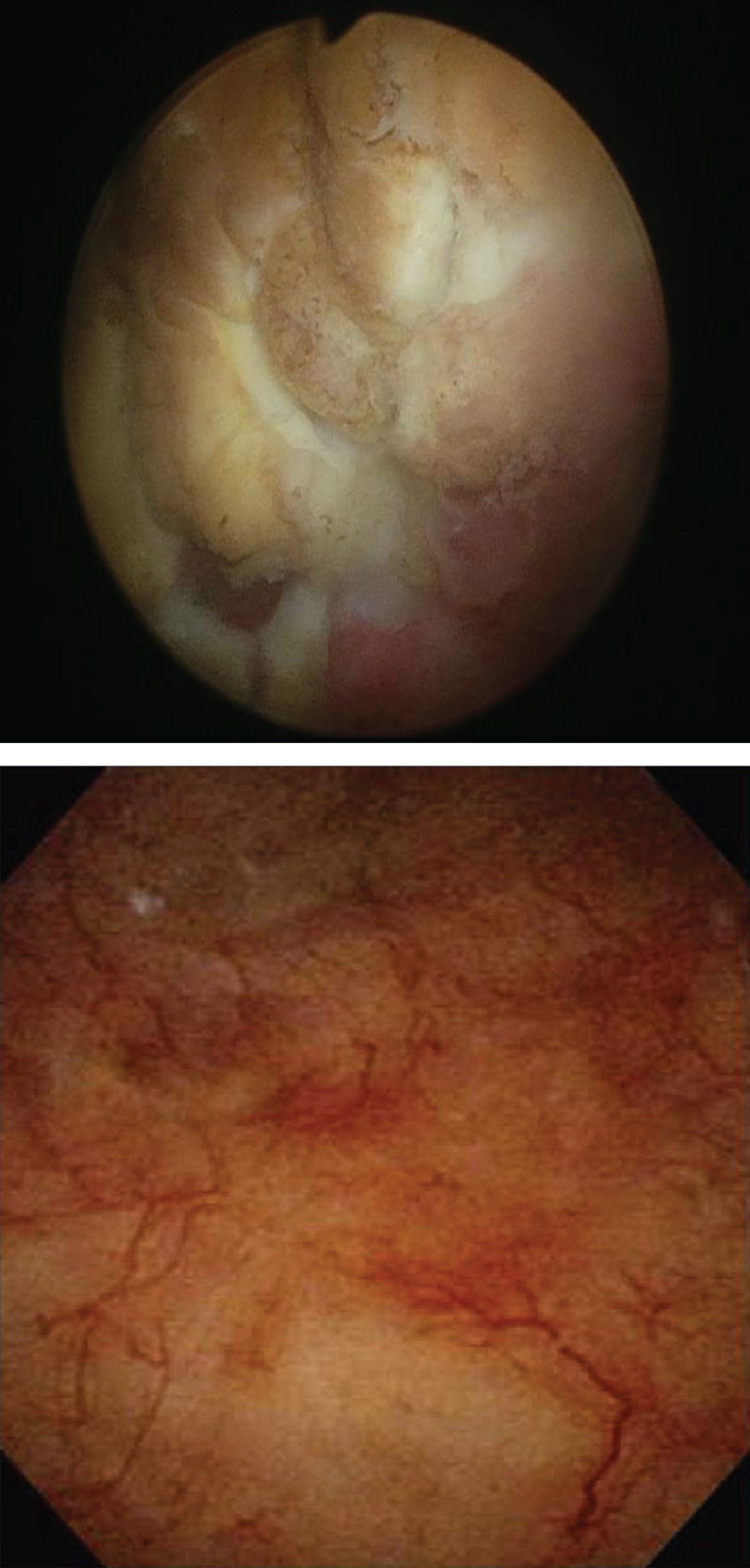 Cystoscopic images: Mitomycin-C induced cystitis pre- and post-treatment (top and bottom respectively) utilizing the algorithm.