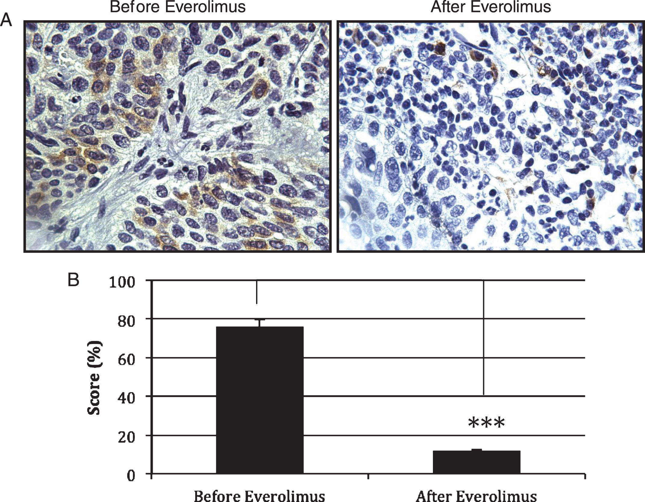 Expression of pS6 as measured of mTOR activity. (A) Immunohistochemistry was used to detect the levels of pS6 in paraffin-embedded tissues of patients treated with Everolimus. (B) Quantification of the immunohistochemistry data in 3 patients with residual disease (n = 3) revealed a significant decrease in pS6 expression as observed in tumors treated with Everolimus (p = 0.021). Treatment of Everolimus started 4 weeks before the combined gemcitabine/radiotherapy treatment. Everolimus was continued during the chemoradiation regimen and for one extra month after the concurrent chemoradiation regimen has been completed.