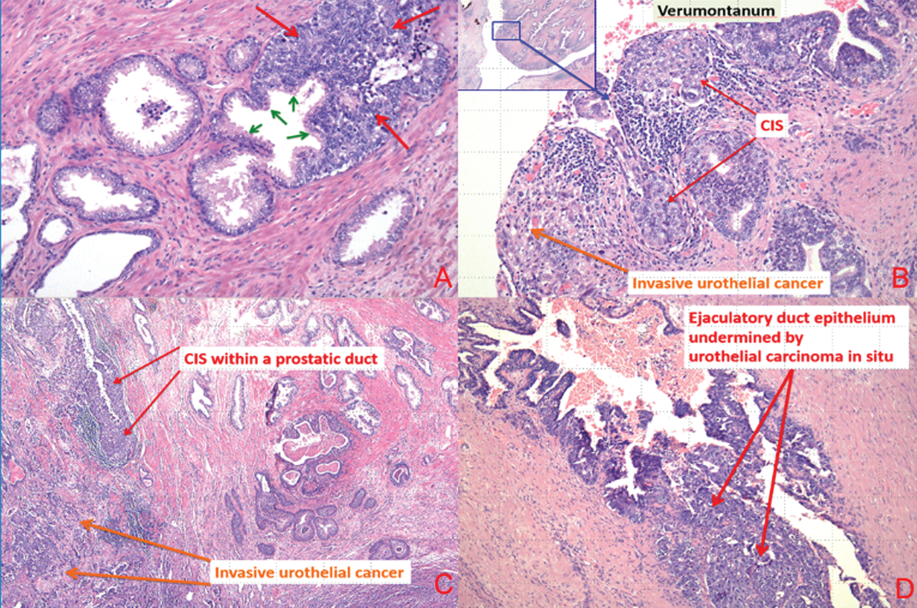 (a) Carcinoma in situ urothelial cells invading prostatic glands (small green arrows represent secretory cell and large red arrows represent urothelial carcinoma in situ). (b) Urothelial carcinoma in situ prostatic urethra and ducts and invasive urothelial carcinoma at the level of verumontanum. (c) Urothelial CIS involving prostatic duct and invasive urothelial carcinoma. (d) Urothelial carcinoma in situ involving ejaculatory duct.