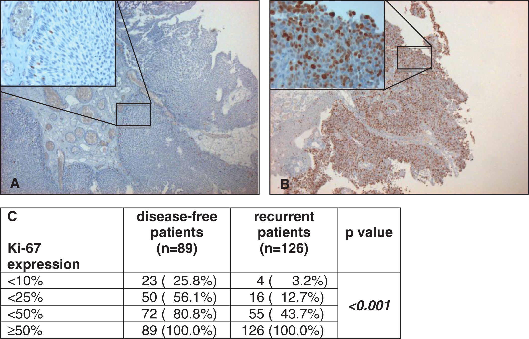 Examples of low (here <10%, A) and strong (here ≥50%, B) staining of Ki-67 under 5 fold and 40 fold (left above) magnification. Correlation of Ki-67 expression with disease-free and recurrent patients by cumulative numbers and rates (C).
