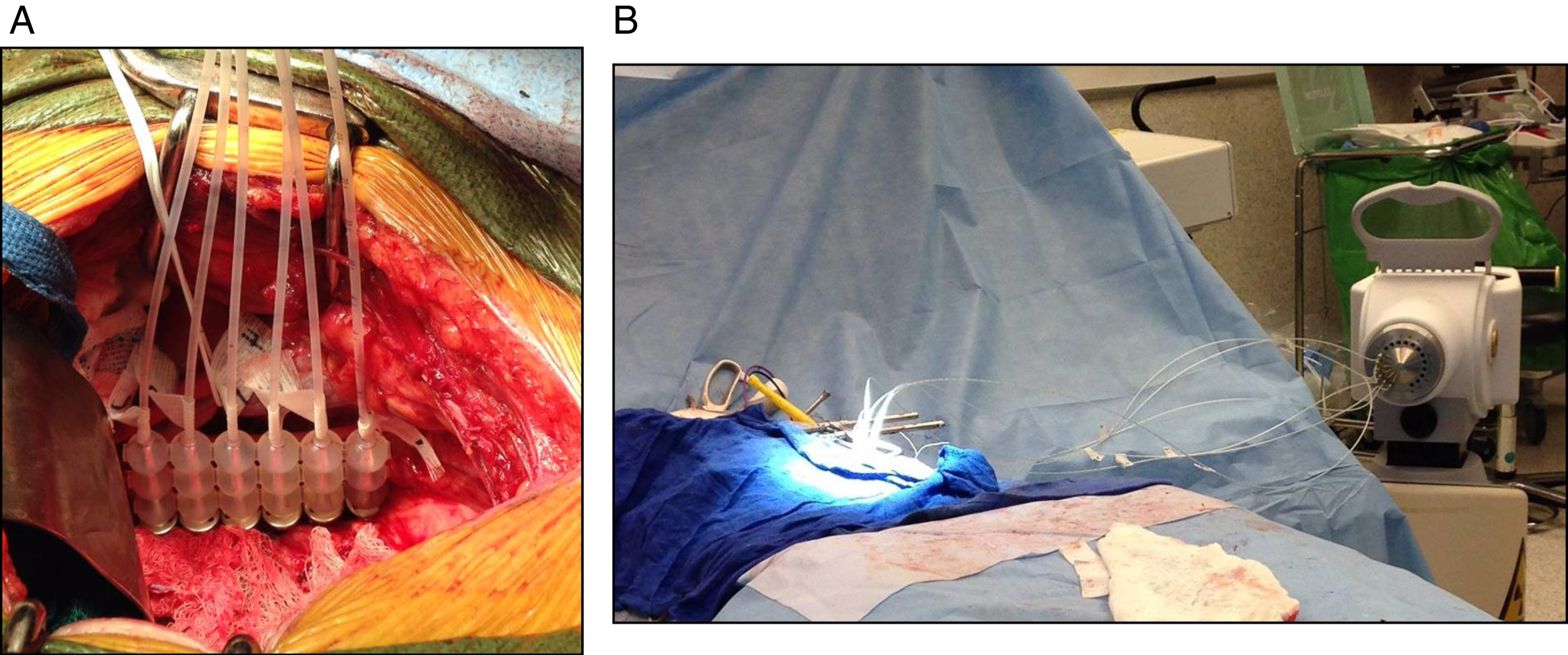 Following resection, (A) the area of interest is isolated from surrounding bowel and ureter, and (B,C) a Freiberg flap is placed with flexible beads and 6Fr catheters connecting to the afterloader.