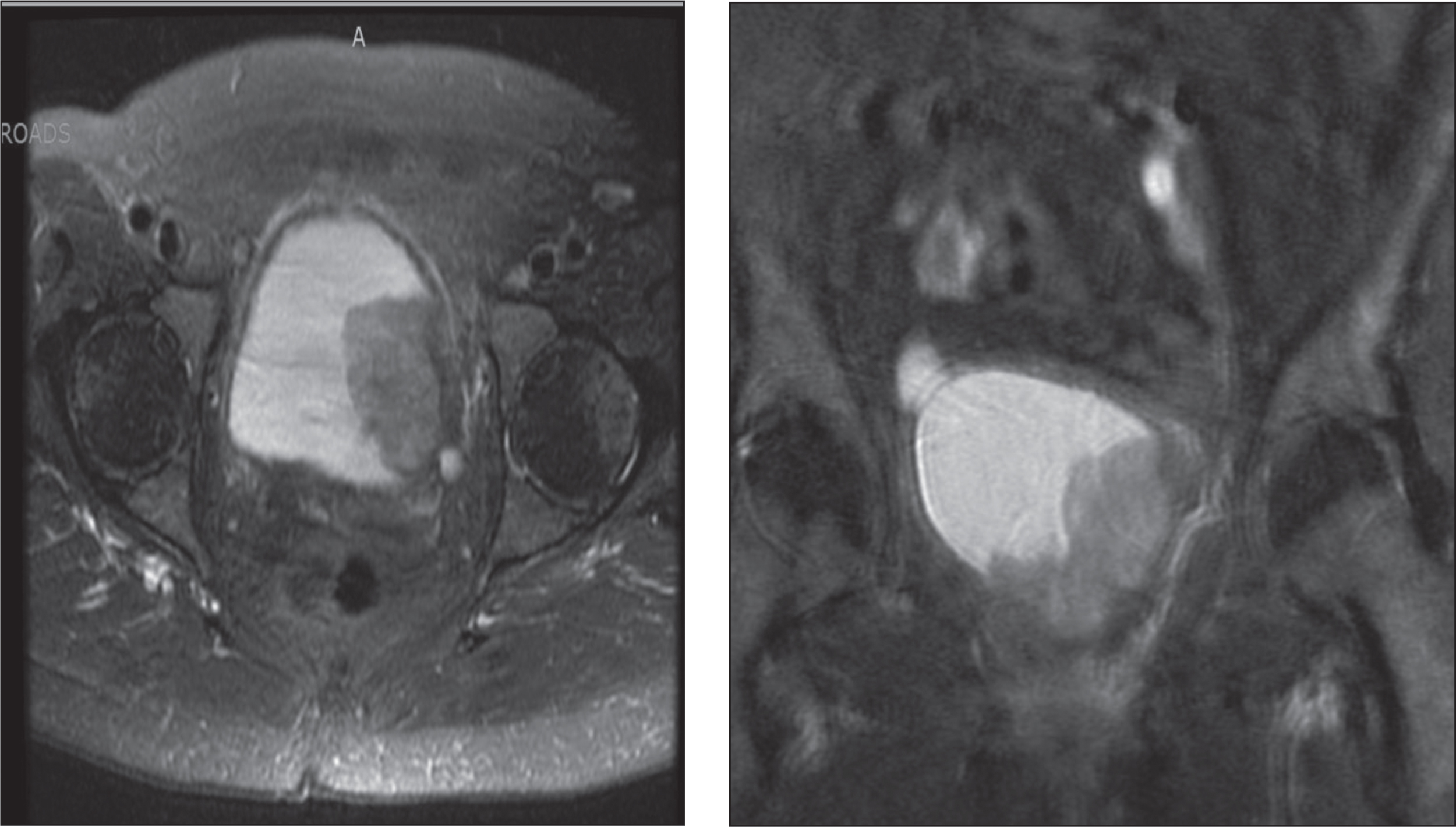 T2 weighted contrast enhanced MRI in axial and coronal views demonstrating bladder tumor appearing to extend into the left perivesical fat.