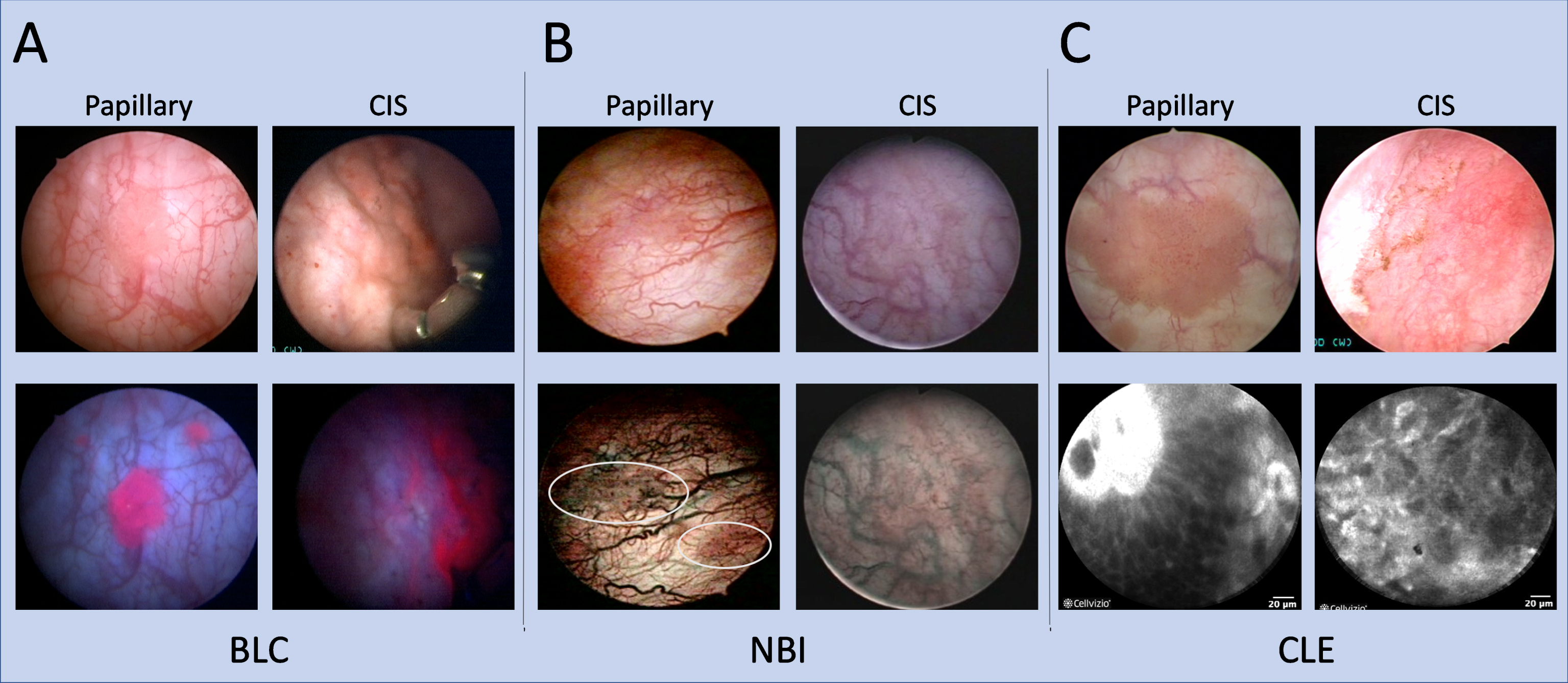 Imaging modalities for improved bladder tumor detection. Papillary and CIS bladder lesions visualized with BLC, NBI, and CLE with corresponding white light images. (A) Positive, red fluorescence of small, satellite papillary tumors seen on BLC that may be missed on WLC. For CIS, red fluorescence also noted on BLC of what appears to be normal urothelium on WLC. (B) NBI improves visualization of aberrant tumor vasculature. Two papillary tumors are more easily visualized on NBI (encircled). For CIS detection, a patch of erythema is more pronounced under NBI compared to a relatively normal appearing urothelium on WLC. CIS images for NBI obtained with permission from [80]. (C) CLE of papillary tumors and CIS provide microscopic detail that can augment macroscopic imaging. A fibrovascular stalk may be visualized as noted in the top left of the papillary CLE example. CIS is notable for a disorganized architecture with pleomorphic cells and indistinct cellular borders.