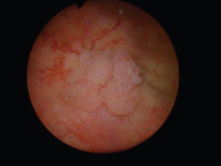 Papillary bladder tumor.