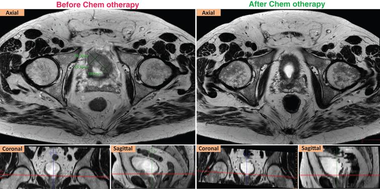 RECIST response of a ypT2aN0 case. Left (axial, coronal, sagittal) T2W images show that the targeted tumor was measured at 4.36 cm in the longest diameter before chemotherapy. Right (axial, coronal, sagittal) T2W images show that the targeted tumor was not seen after chemotherapy.