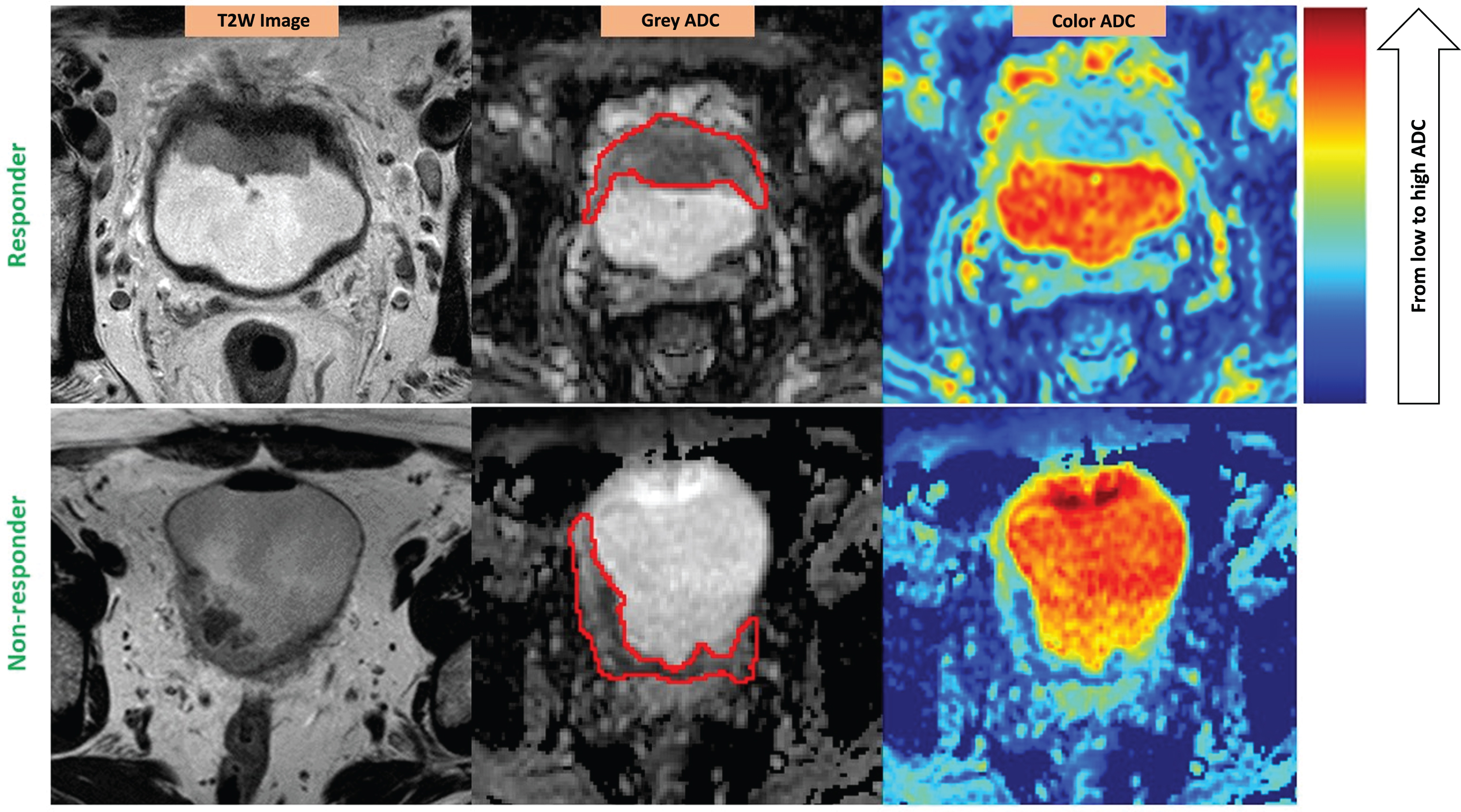 ADC heterogeneity in the bladder tumor of a responder (upper) vs. a non-responder (lower). Red contours illustrate the ROIs placed on the tumors. The color scale column is given on the right. ADC values are scaled with the color spectrum from the lowest ADC at the bottom to the highest ADC at the top of the column. Please note that higher micro-cellularity underlies lower ADC in tumor tissues. Responder (stage pT1N0): U = 0.08; E = 3.81; Non-responder (stage pT3bN0): U = 0.06; E = 4.12.
