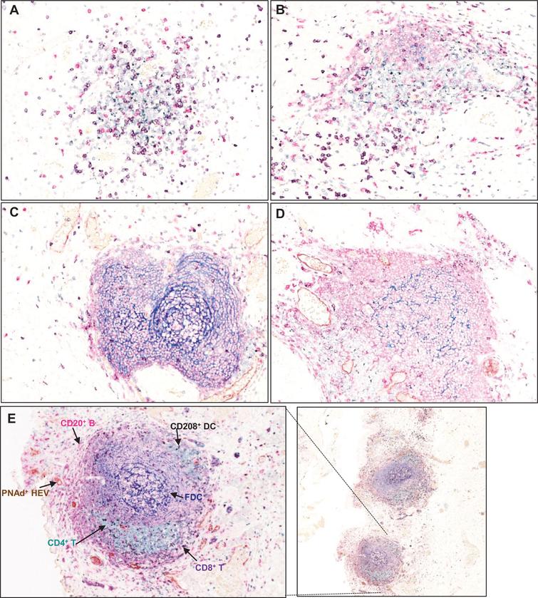 Developmental continuum of TLS in bladder tumours. Multi-color IHC performed on 5 μm thick sections from formalin fixed paraffin embedded bladder tumour tissue to reveal features associated with the TLS architecture. Different Types of aggregates and immune cell distributions were defined as previously described by Kroeger et al., [20], A) Type I B) Type 2 C) Type 3 and D) Type 4 aggregates. E) Well formed tertiary lymphoid structure in high grade muscle invasive bladder tumour showing CD3+ (green) and CD8+ T lymphocytes (purple), CD20+ B lymphocytes (pink), CD21+ follicular dendritic cells (blue), CD208+ mature dendritic cells (black), PNAd+ high endothelial venule (brown).
