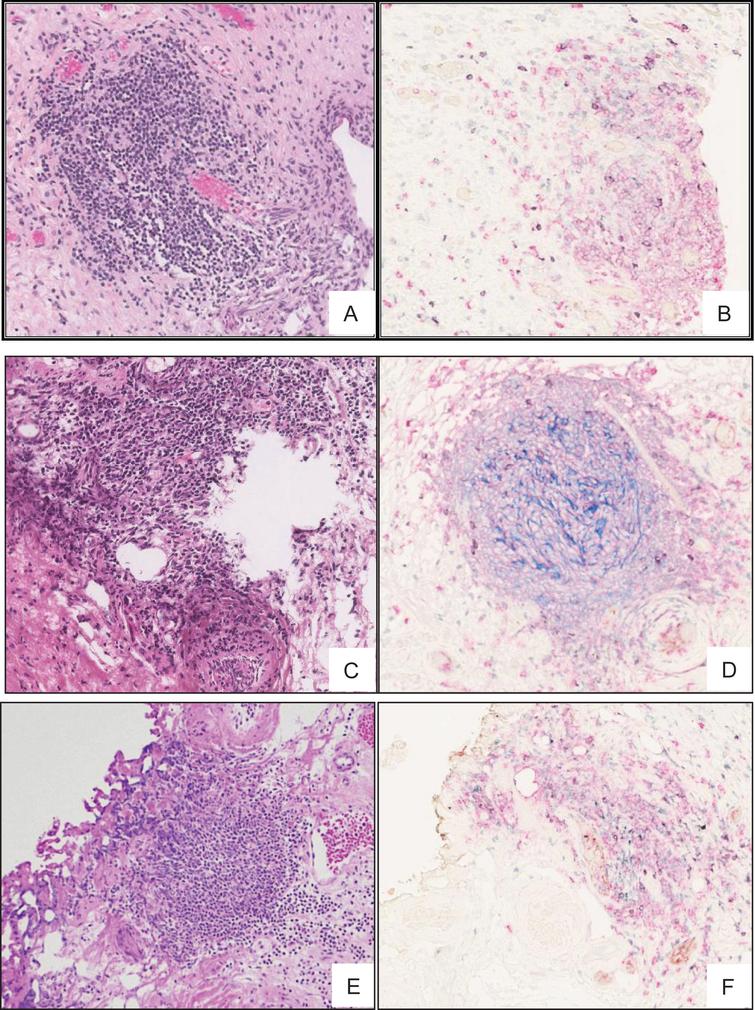 Lymphoid aggregates in low grade MIBC. H & E stained 5 μm thick FFPE section of a low grade NMIBC tumour showing lymphoid aggregation (A, C and E) further confirmed by staining with multi-color IHC (B, D and F) markers specific to TLS including showing CD20+ B cells (pink) and CD8+ T cells (purple).