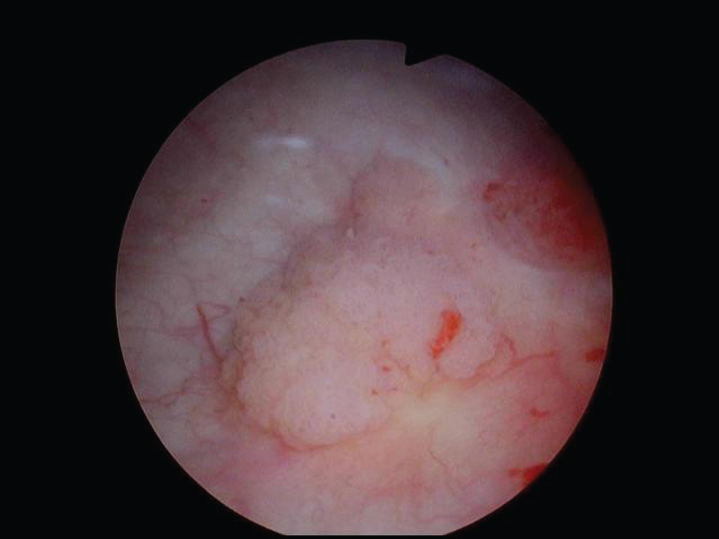 Papillary Ta appearing tumor. One of multiple similar appearing tumors.