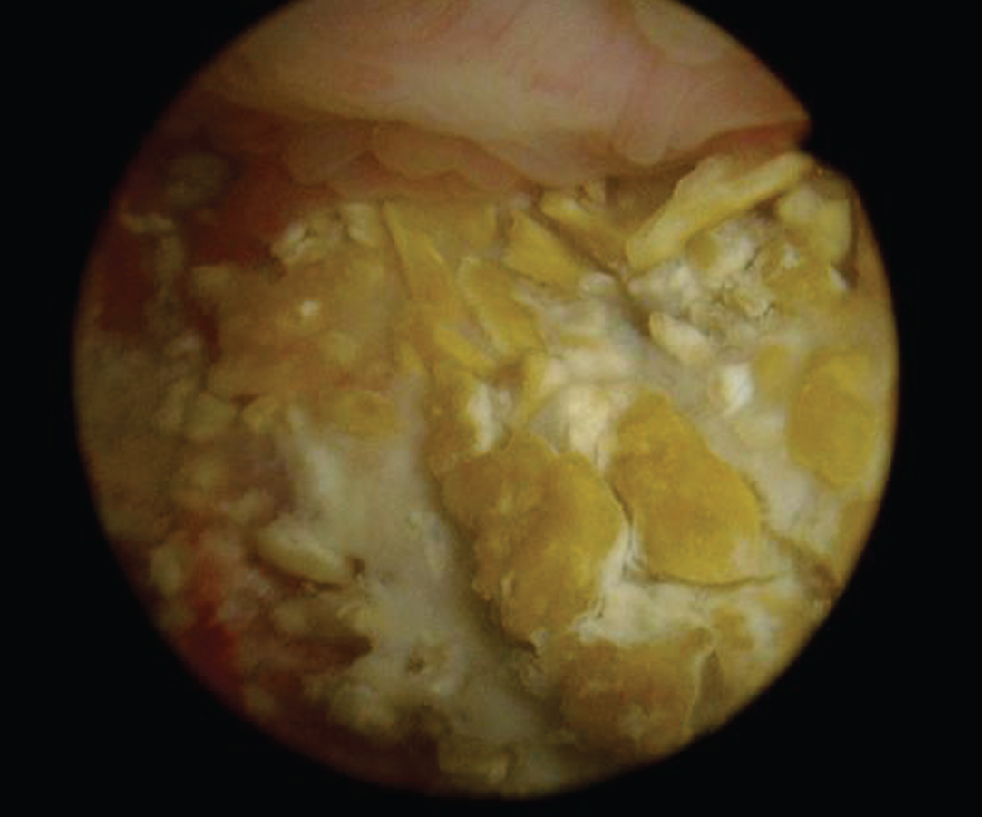 Endoscopic view of the calcified urothelium in March 2017.