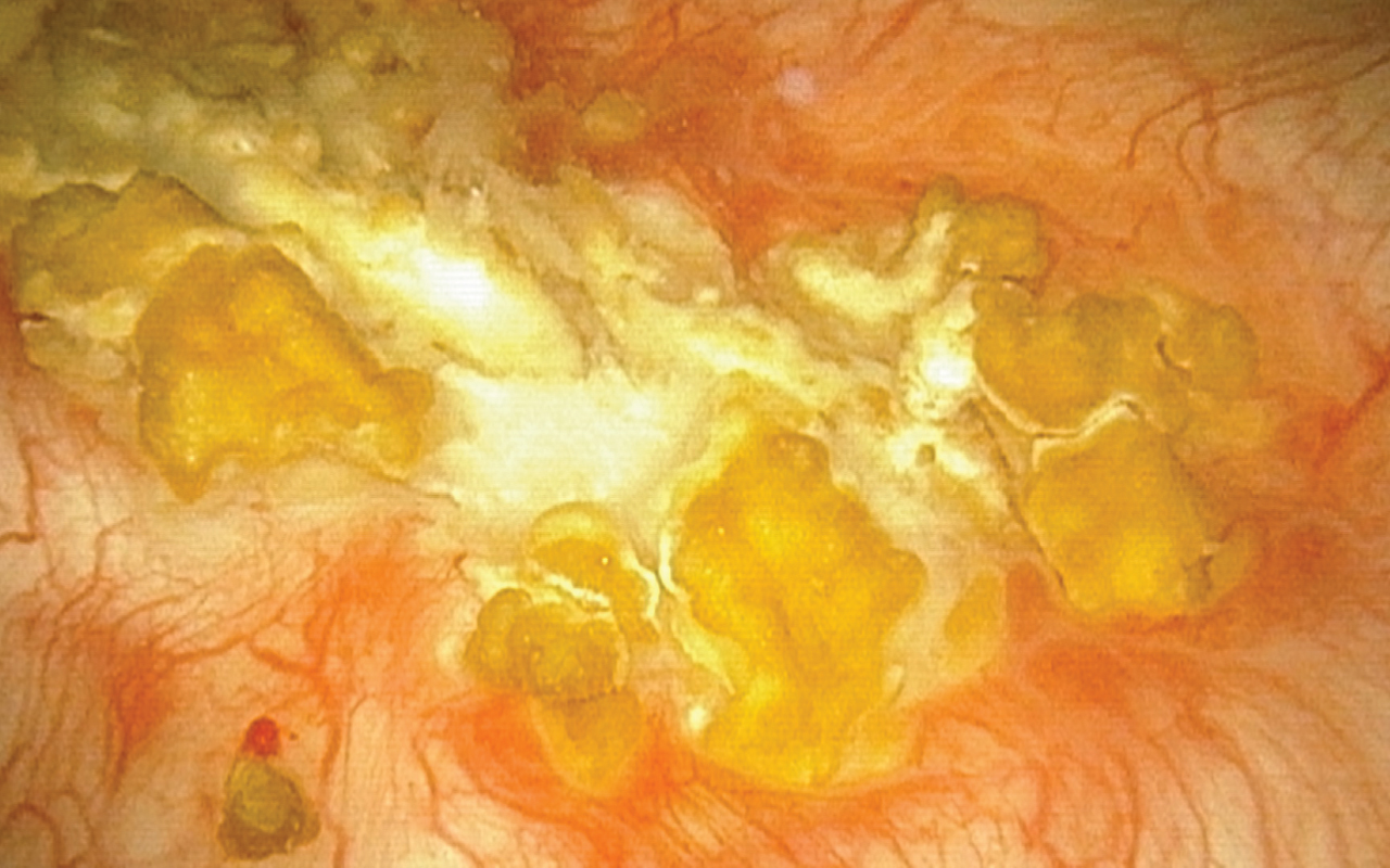 Office endoscopic photo of the calcified surface on the posterior wall of the bladder, Oct 2017.