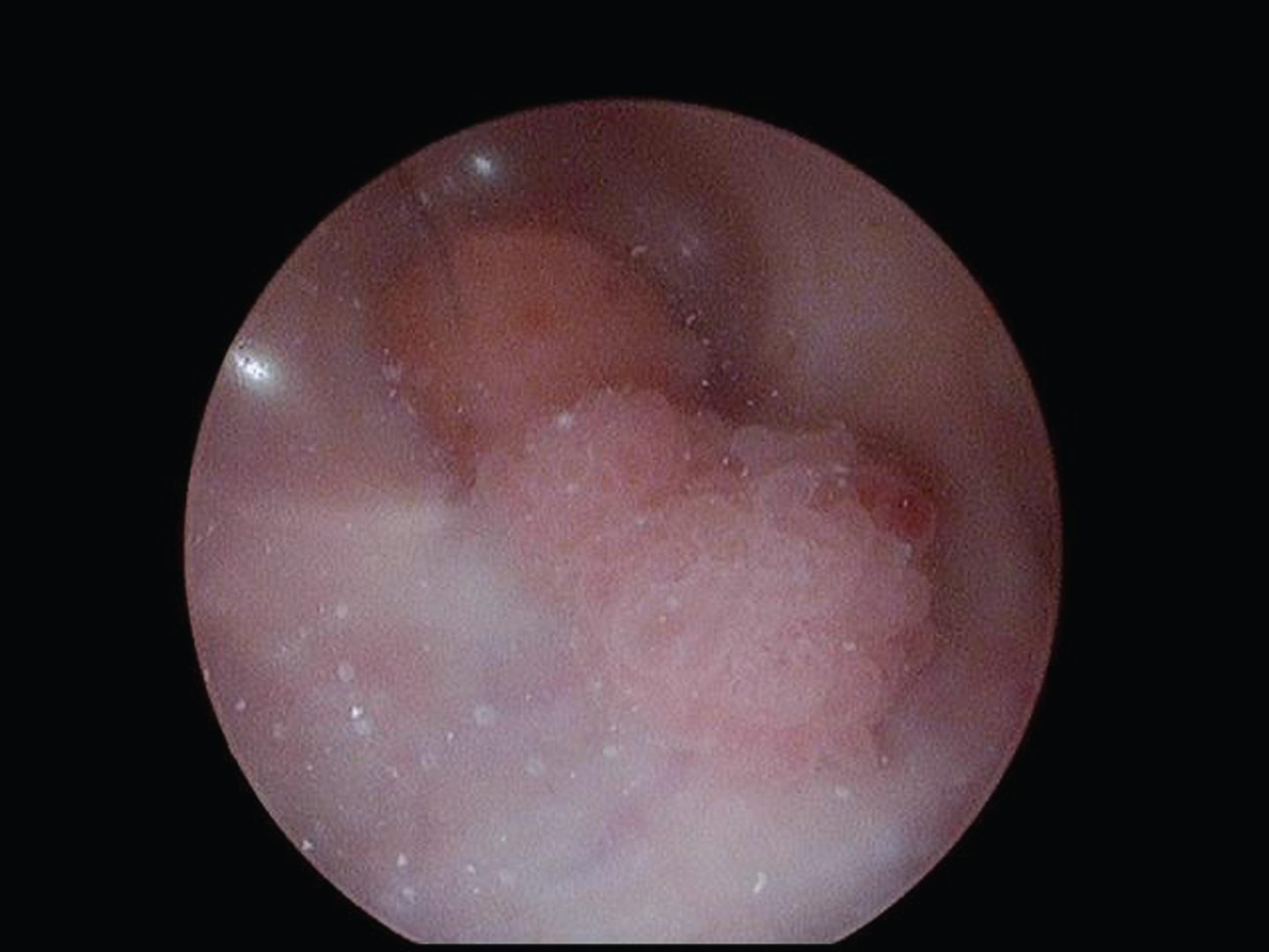 2–3 cm papillary tumors posterior wall.