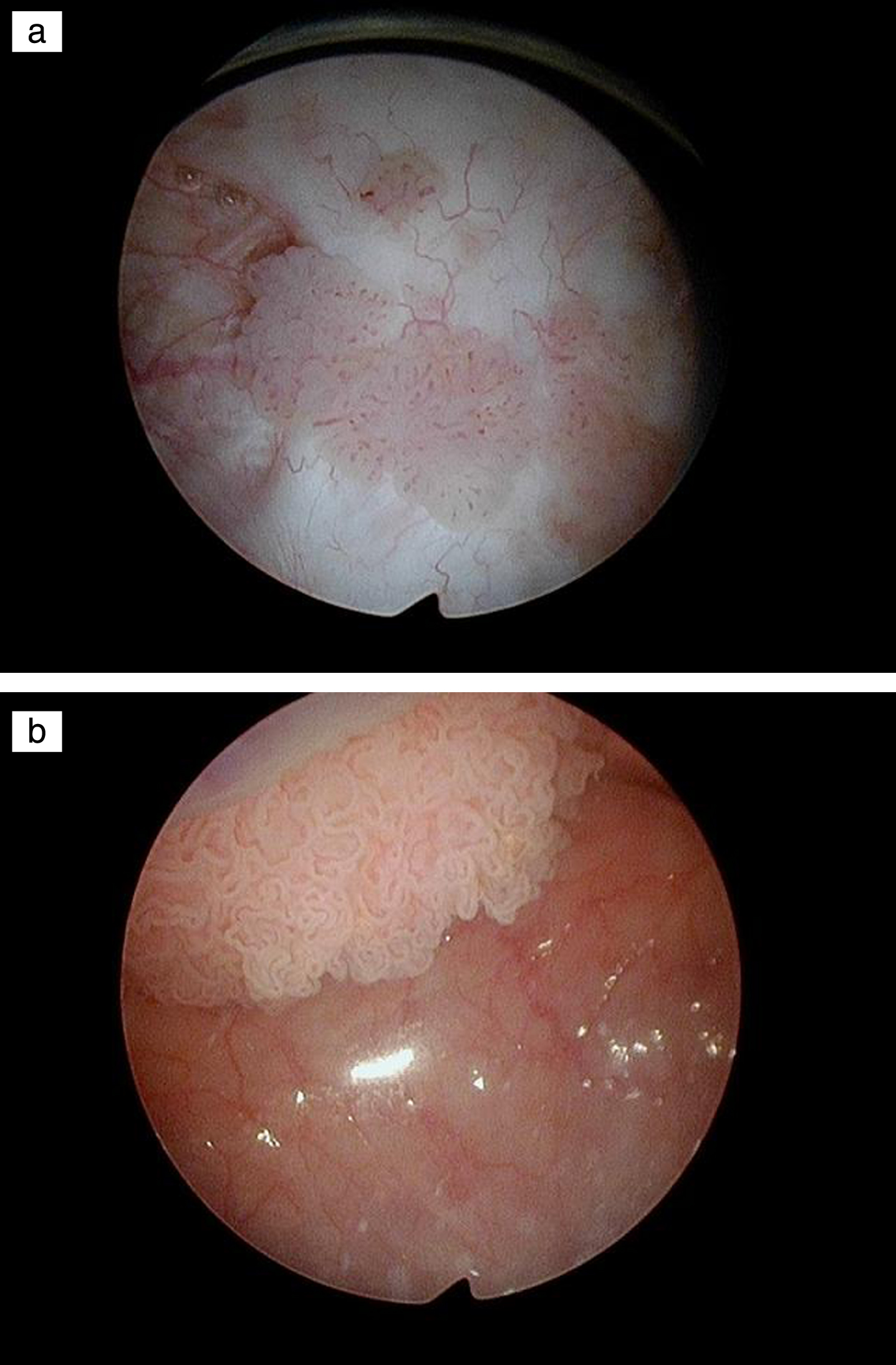 Papillary bladder tumors.