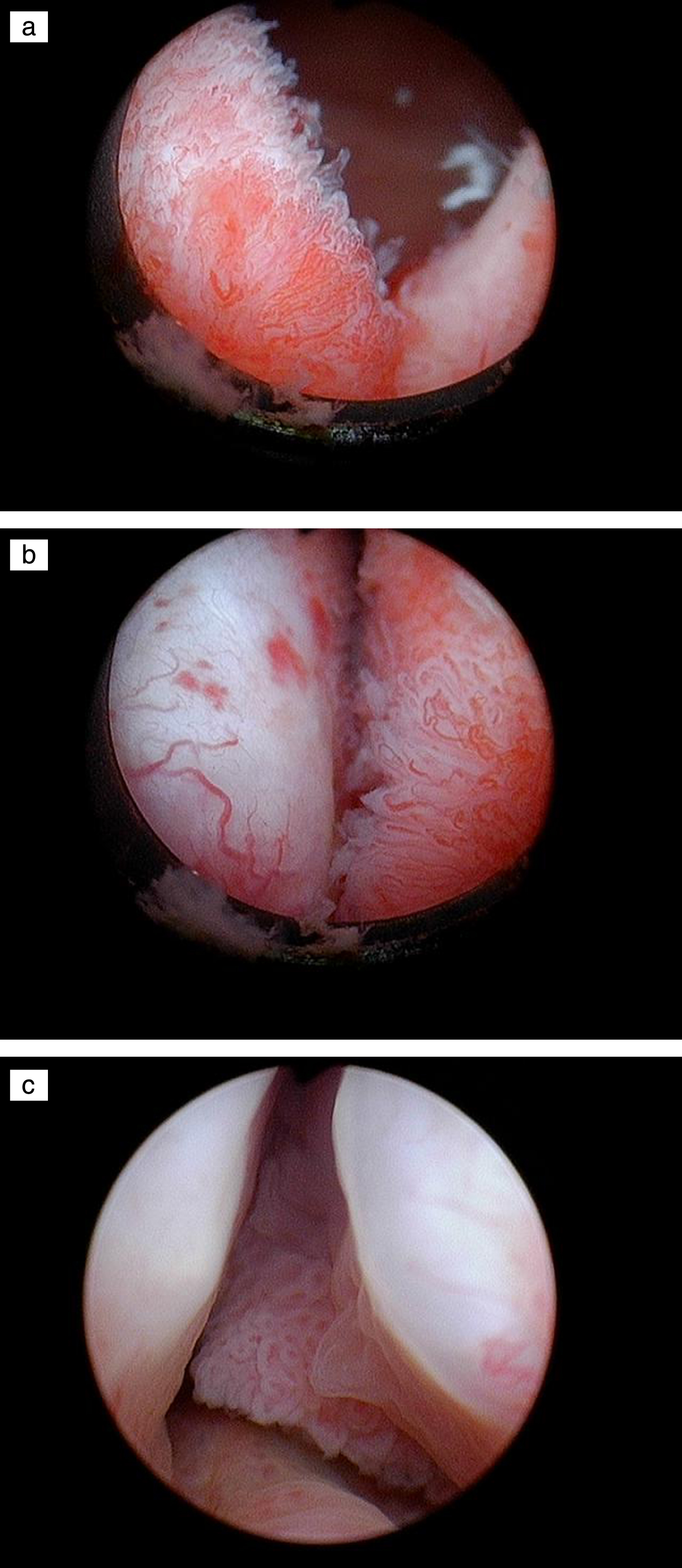 Papillary tumor in the prostatic urethra.