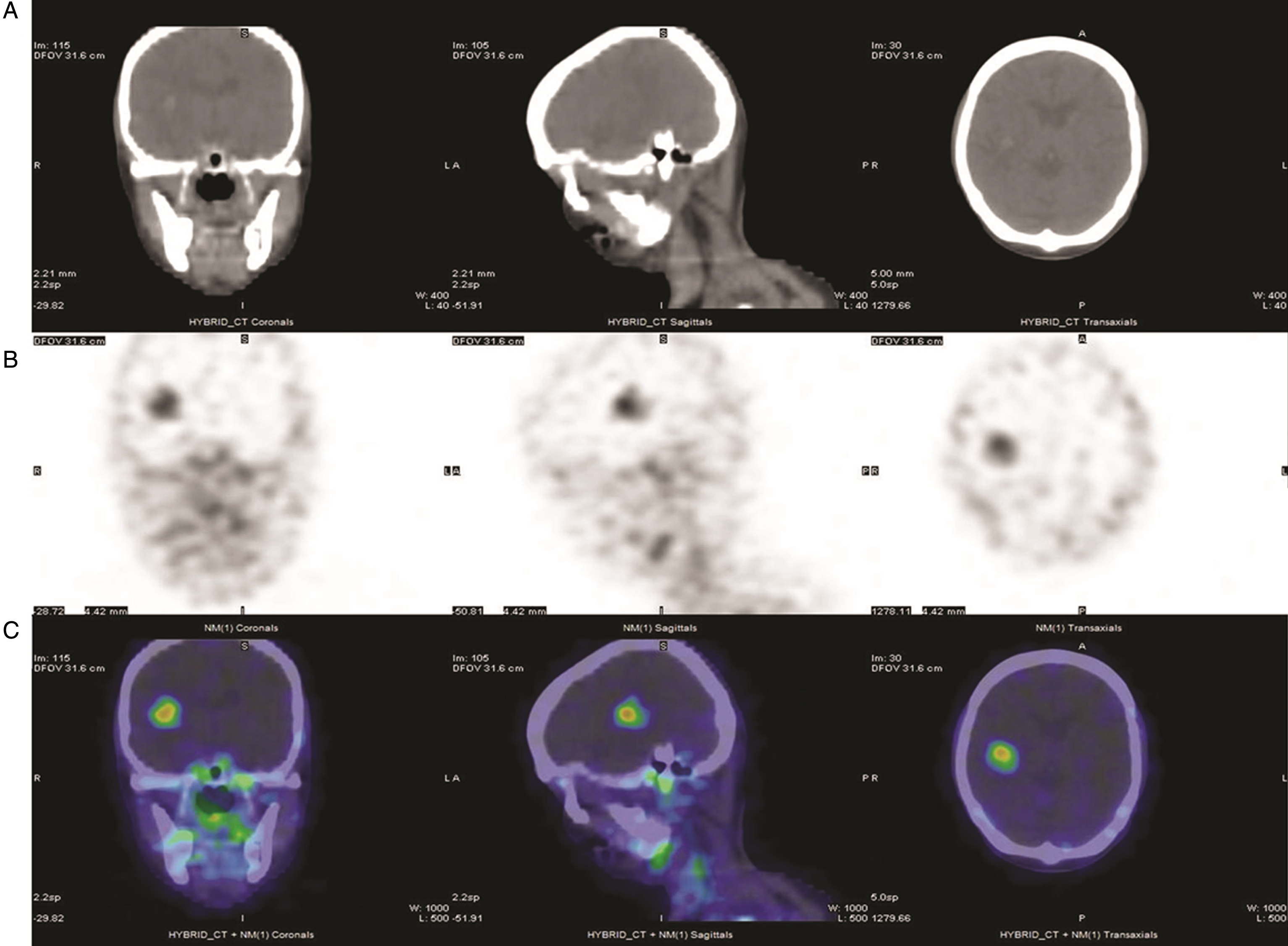 111In-J591 single-photon-emission tomography (SPECT) in a patient with metastatic bladder urothelial carcinoma (UC). From left to right: coronal, sagittal and transaxial views from SPECT/CT obtained 72 hours after the administration of 5.55 mCi In-111 DOTA J-591. (A) CT images of the head showing a focal hyperintense lesion with surrounding edema in the right hemisphere. (B) SPECT images of the head in grayscale and (C) in color scale, showing multiple foci of increased uptake in the brain, skull, mandibles and cervical nodes.