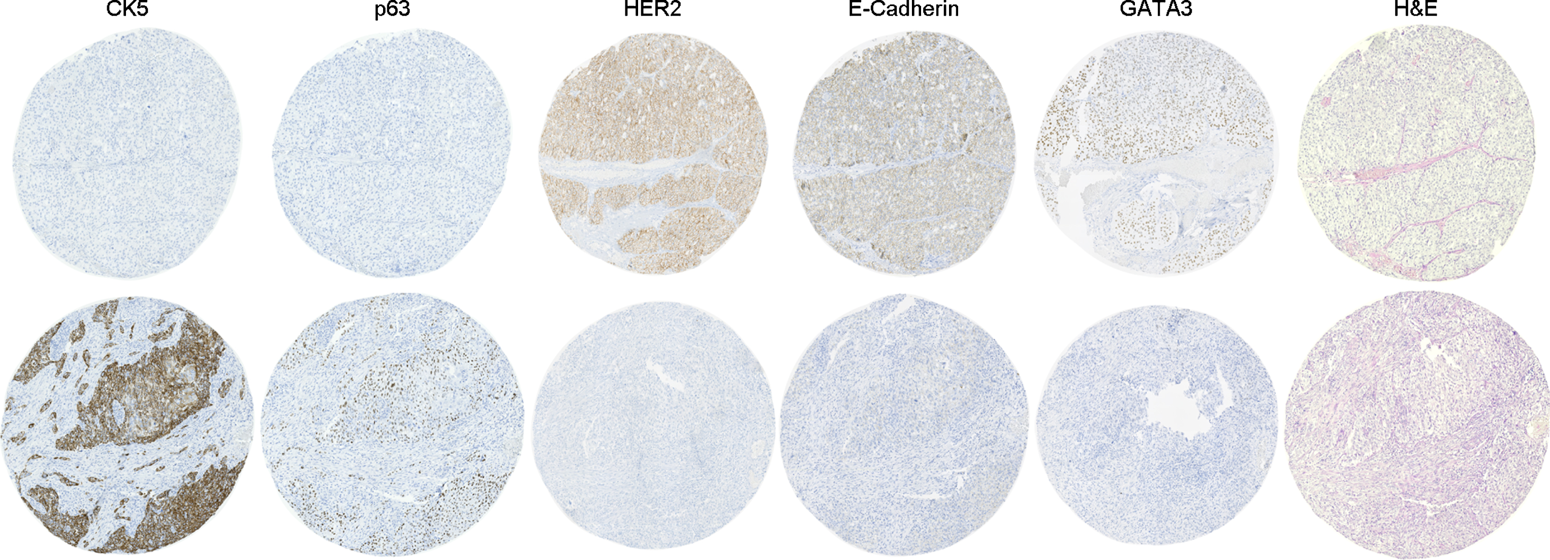 Representative images of routine hematoxylin and eosin (H&E) staining and intercore heterogeneity in five markers (CK5, E-Cadherin, GATA3, HER2 and p63) in two different cores from the same tumor.