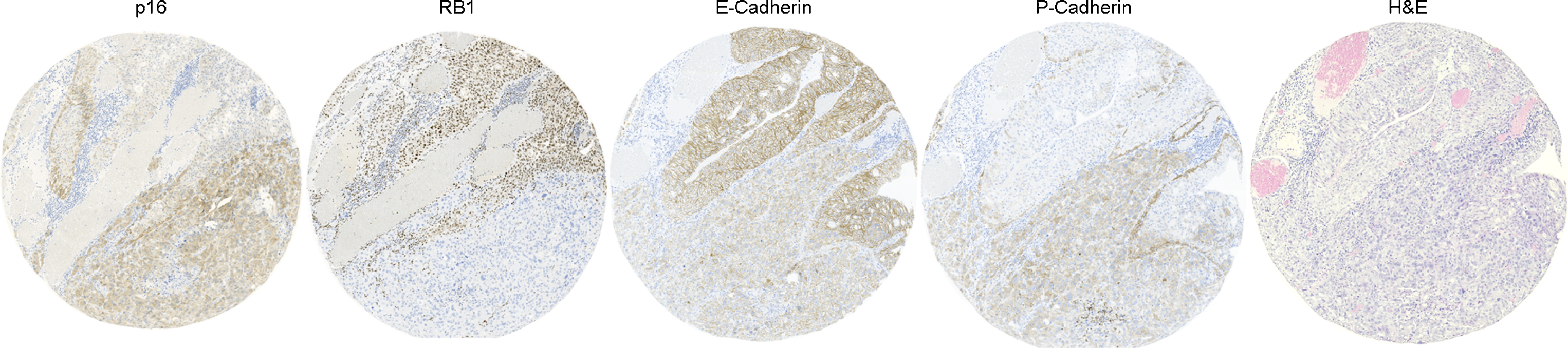 Representative case showing intracore heterogeneity. Routine hematoxylin-eosin staining (H&E) and four markers (E-Cadherin, p16, P-Cadherin and RB1) are shown.